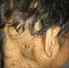 Minoxidil-Induced Hypertrichosis in Child with Alopecia Areata – ScienceOpen