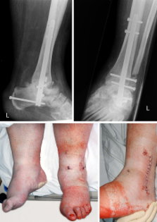 The use of a retrograde fixed-angle intramedullary nail for tibiocalcaneal  arthrodesis after severe loss of the talus – ScienceOpen