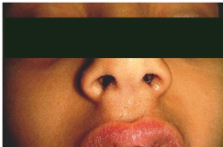 Congenital Median Upper Lip Fistula – ScienceOpen