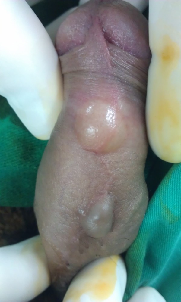 Cysts Of The Penis 20