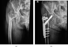 Dynamic Hip Screw with Trochanter-Stabilizing Plate Compared with Proximal  Femoral Nail Antirotation as a Treatment for Unstable AO/OTA 31-A2 and  31-A3 Intertrochanteric Fractures – ScienceOpen