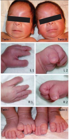 Rubinstein - Taybi Syndrome (Rubinstein syndrome, broad thumb