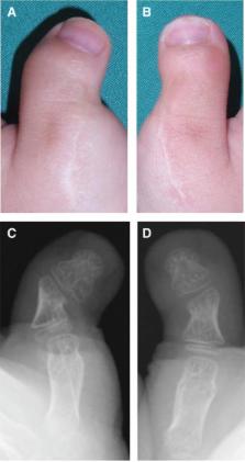 Rubinstein-Taybi syndrome  Radiology Reference Article