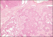 Polypoid Basal Cell Carcinoma Masquerading As Pyogenic Granuloma