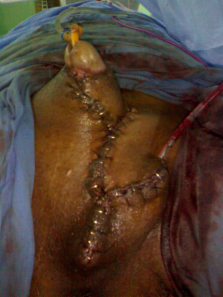 A Rare Case Of Giant Leiomyosarcoma In A Filarial Scrotum A Case