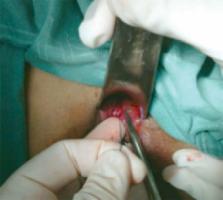 Como e a cirurgia de fistula anal