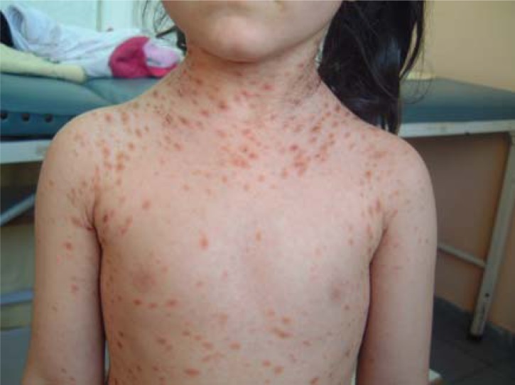 Pityriasis rosea (Christmas tree rash) skin disease causes ...