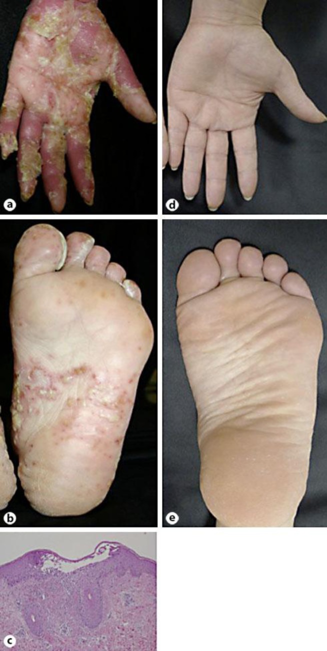 Image result for anti-tnf psoriasis